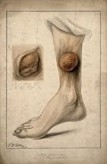 Tuberculosis Prints: Tertiary tubercular elephantiasis on the thigh and calf of a woman