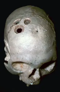 Trepanned Skull Trepanned Skull