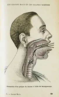 Using a laryngoscope to aid the removal of a polyp from the throat, c1890